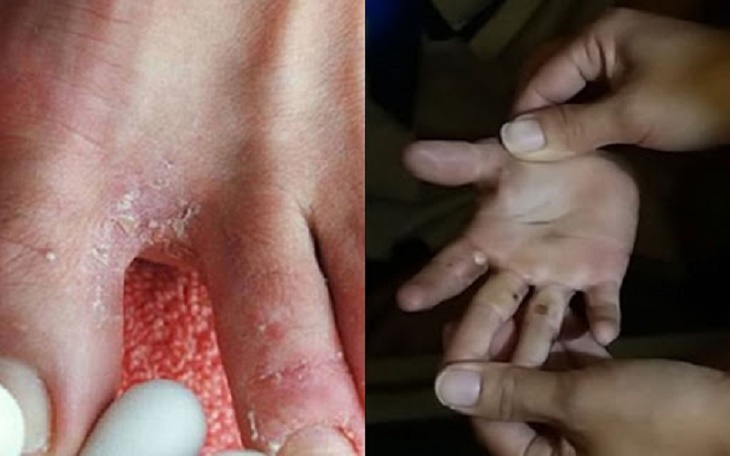 Bị nổi mẩn đỏ ngứa ở chân tay là bệnh lý gì? Mức độ nguy hiểm