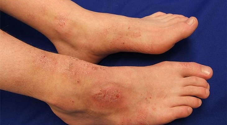 Nổi mẩn đỏ ngứa ở chân đa phần do bệnh da liễu