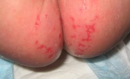 Nổi mẩn đỏ ở mông nhưng không ngứa và 5 bệnh lý nguy hiểm bạn cần biết