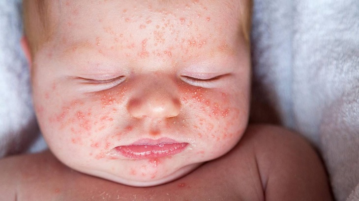 Nổi mẩn đỏ ở trẻ sơ sinh là gì? Cách trị an toàn hiệu quả