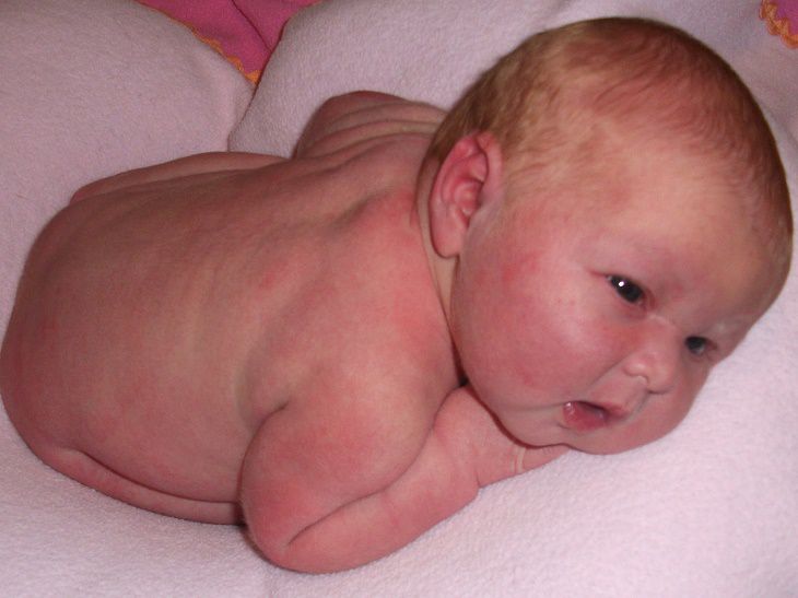 Hình ảnh nhận biết dấu hiệu nổi mẩn đỏ ở trẻ sơ sinh