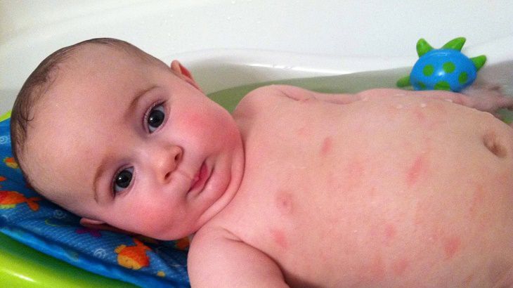Nổi mẩn đỏ ở trẻ sơ sinh có thực sự đáng ngại?