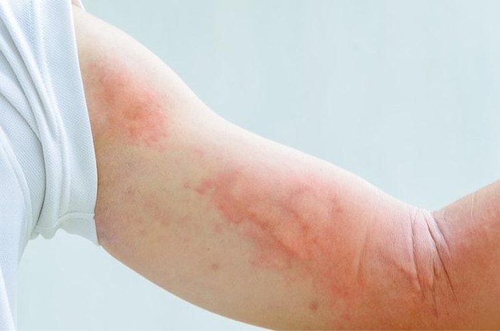 Ngứa mẩn đỏ dưới da là dấu hiệu bệnh gì?