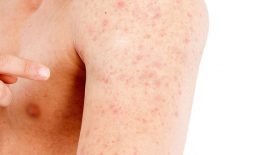 Nguyên nhân gây nổi mẩn đỏ dưới da không ngứa là bệnh gì?