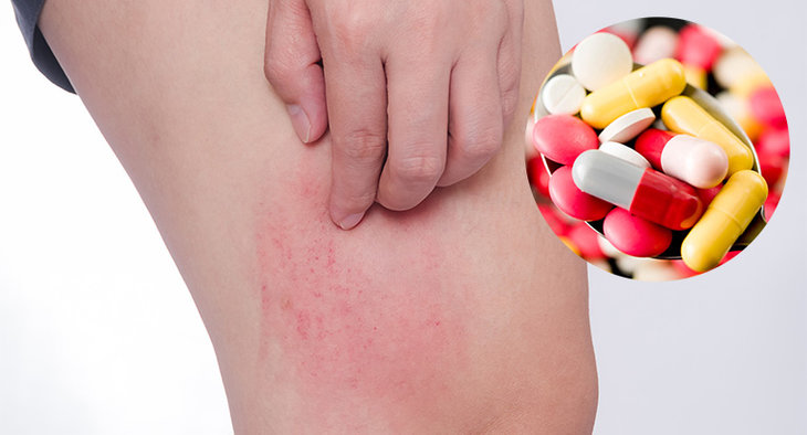 Dị ứng thuốc có thể là nguyên nhân gây nổi mẩn đỏ trên da