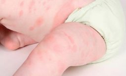Bé nổi mẩn đỏ khắp người sau sốt là bệnh gì?
