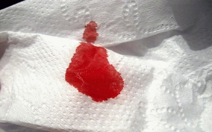 Trĩ chảy máu ban đầu rất khó phát hiện, thường chỉ dính trên giấy vệ sinh