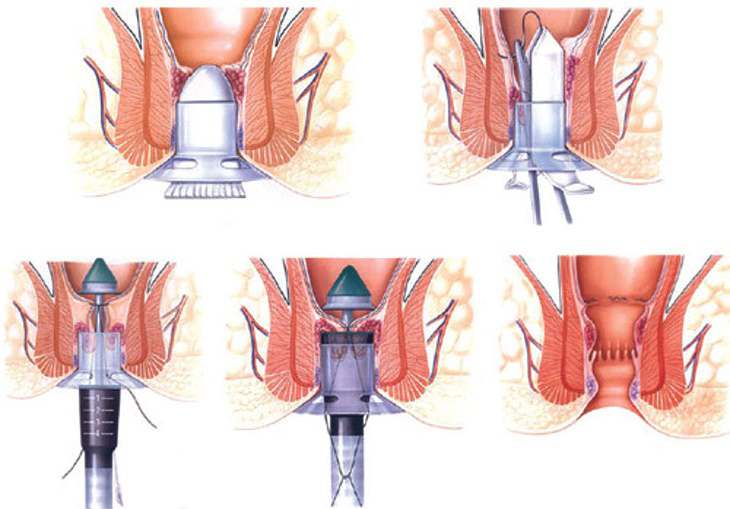 Phẫu thuật cắt trĩ là cách điều trị hiệu quả nhưng khá nguy hiểm
