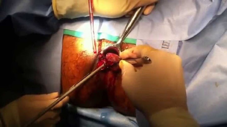 Phẫu thuật cắt trĩ