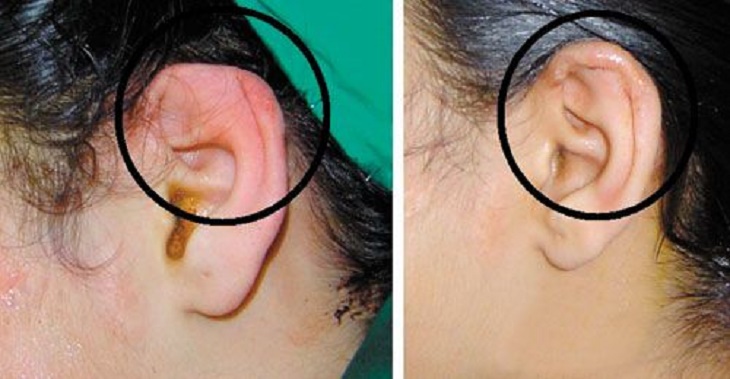 Vảy nến ở tai rất hiếm gặp, nhưng nếu mắc phải có thể bị khiếm thính