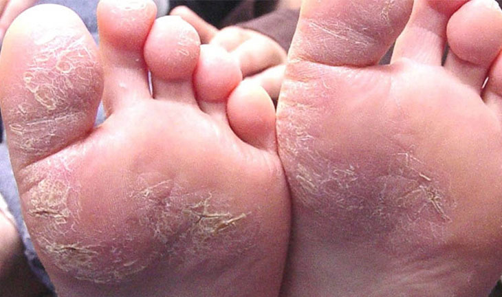Viêm da cơ địa ở chân gây nhiều phiền phức cho người bệnh