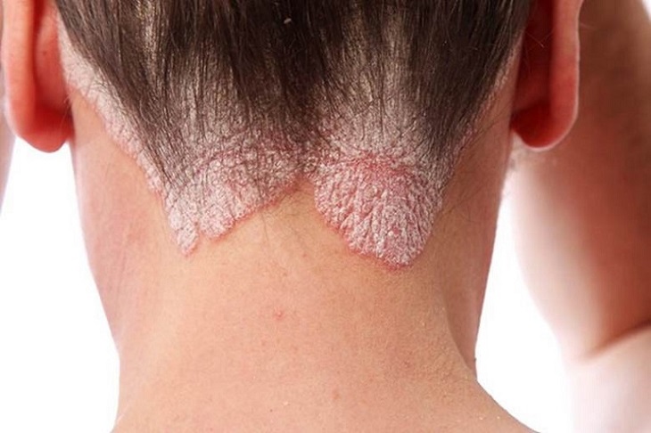 Dấu hiệu bệnh viêm da cơ địa ở đầu là tại chân tóc, vùng trán, gáy, xuất hiện các mảng da màu đỏ.