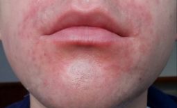 Viêm da cơ địa quanh miệng: Nguyên nhân, triệu chứng và cách điều trị