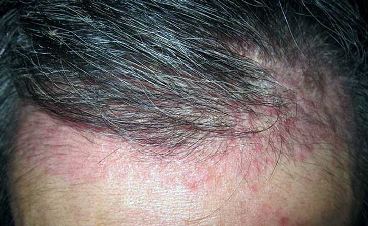 Viêm da tiết bã nhờn ở đầu gây ra các tổn thương điển hình như khiến da đầu đổ nhiều dầu, bề mặt da đỏ và bong vảy