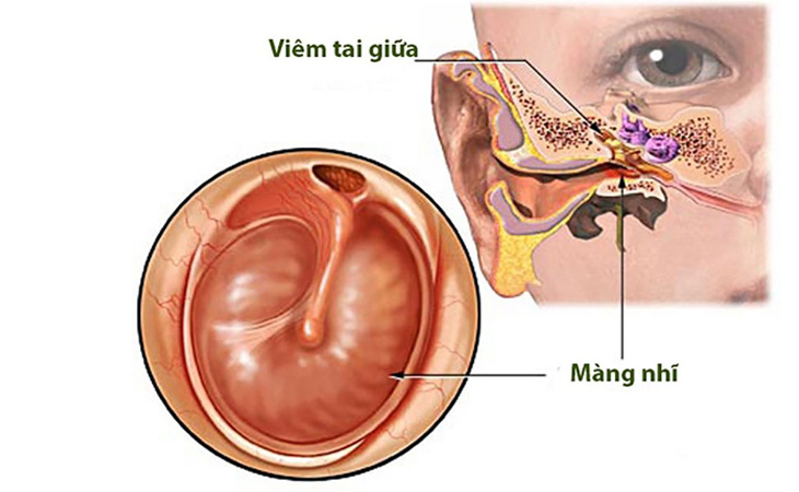 Bệnh viêm tai giữa mãn tính thủng nhĩ