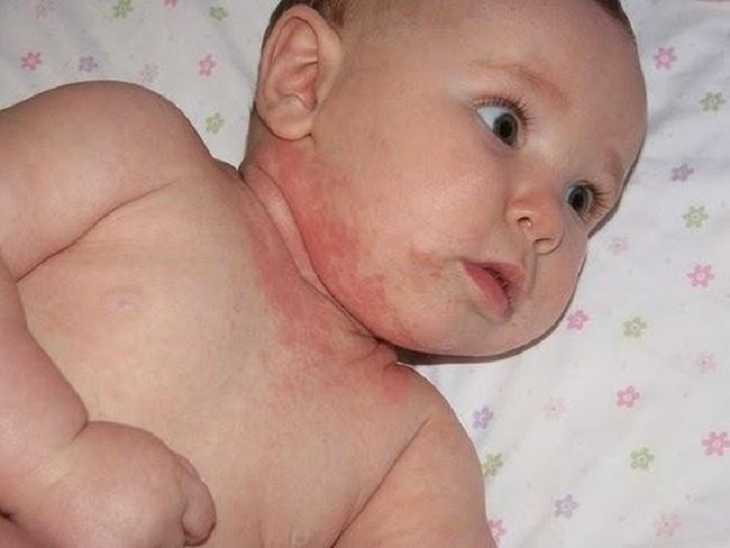 Nổi mẩn đỏ ở bé thường là lành tính