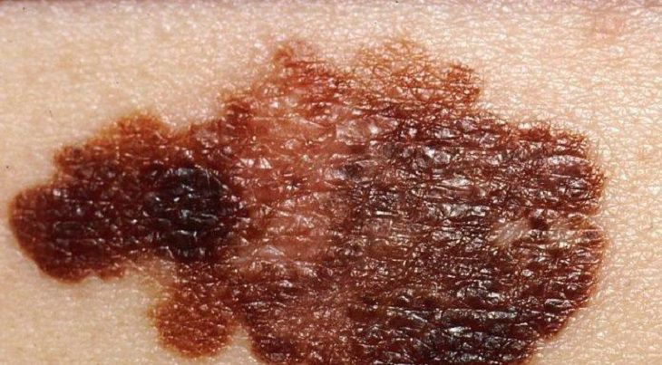 Điều trị vảy nến bằng quang hoá trị liệu có thể gây sạm da