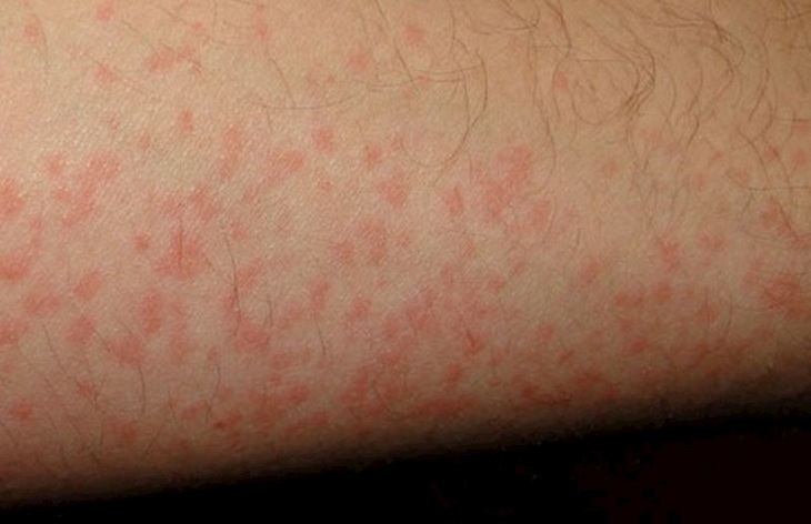 Lupus ban đỏ gây các nốt mẩn đỏ trên da nhưng không ngứa