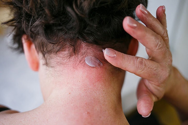 9 Thuốc trị vảy nến da đầu tốt nhất hiện nay và những lưu ý khi sử dụng