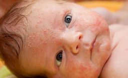 Trẻ bị nổi mẩn đỏ trên mặt gây ảnh hưởng đến sự phát triển