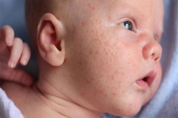 Có nhiều nguyên nhân khiến trẻ bị nổi mẩn đỏ ở trên mặt