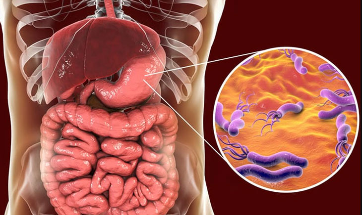 Viêm dạ dày HP dương tính là tình trạng vi khuẩn xâm nhập và tấn công niêm mạc dạ dày