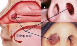 Viêm xoang polyp mũi là tình trạng người bệnh có polyp mũi và bị viêm xoang