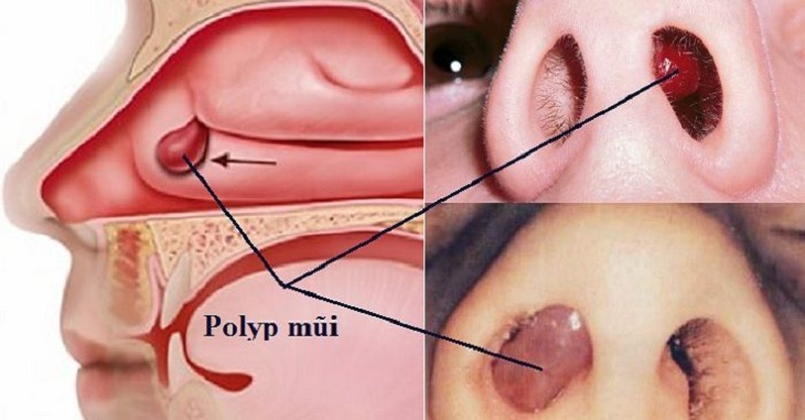 Viêm xoang polyp mũi là tình trạng người bệnh có polyp mũi và bị viêm xoang
