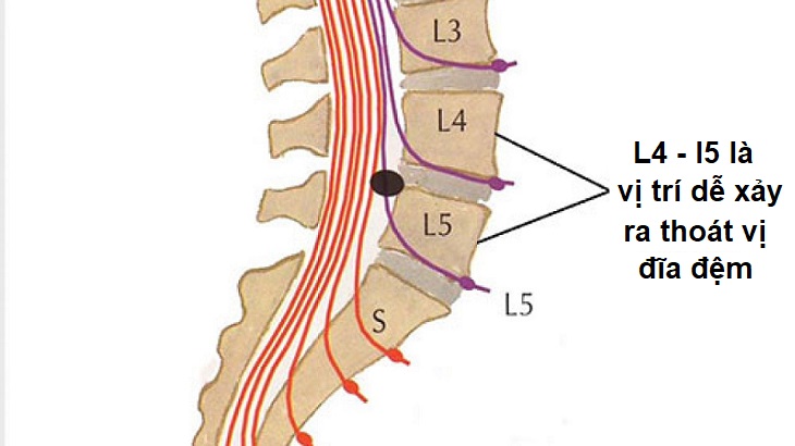 Phồng đĩa đệm L4 - L5 là bệnh xương khớp phổ biến, có thể gây nhiều vấn đề nguy hại đến sức khỏe và hệ vận động