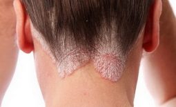 Á sừng da đầu là một thể của bệnh á sừng và là một loại bệnh viêm da cơ địa khá phổ biến