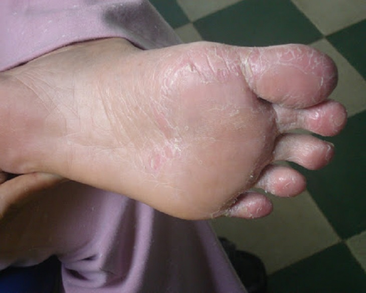 Bệnh á sừng ở chân là bệnh lý da liễu chỉ tình trạng viêm da cơ địa ở chân