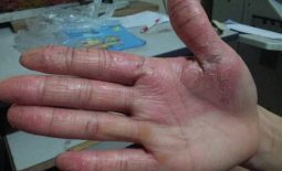 Bệnh á sừng ở tay là bệnh lý da liễu, còn được gọi tên là tình trạng viêm da cơ địa ở tay hoặc là bệnh Eczema