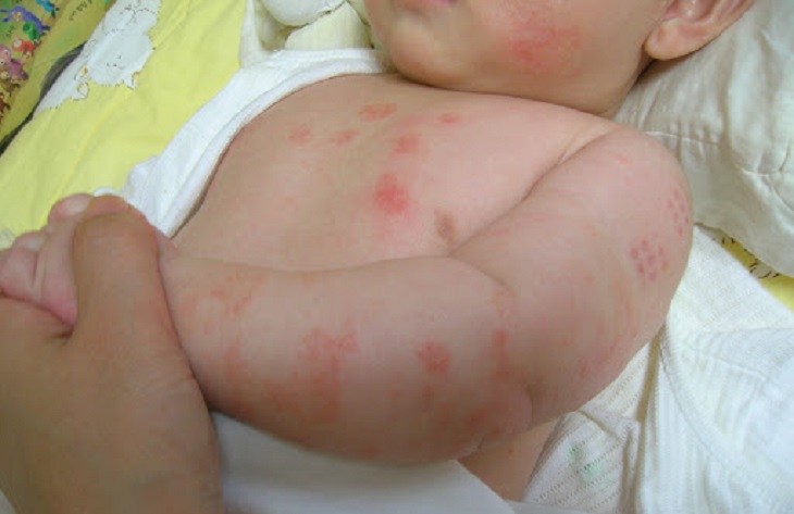 Vảy nến ở trẻ nhỏ có nhiều loại và dễ bị nhầm lẫn với các vấn đề về da khác
