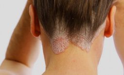 Vảy nến da đầu là bệnh lý da liễu mãn tính thường gặp và không thể điều trị triệt để