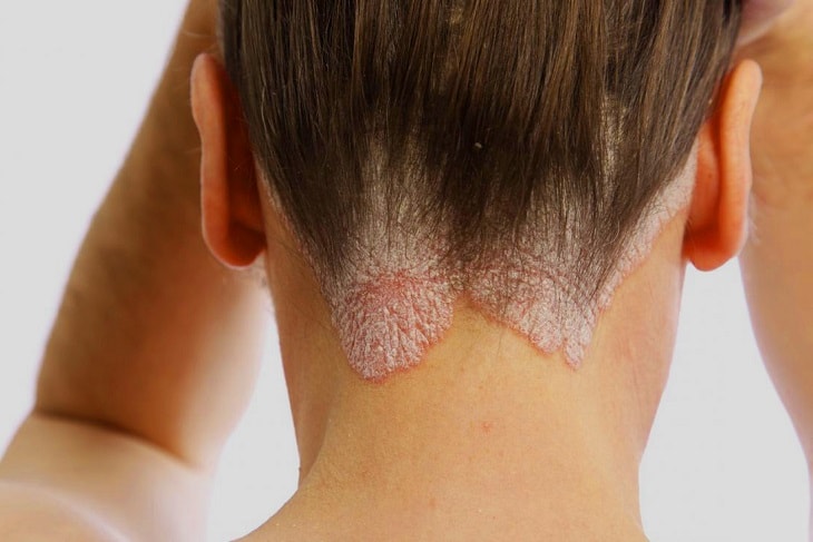 Vảy nến da đầu là bệnh lý da liễu mãn tính thường gặp và không thể điều trị triệt để