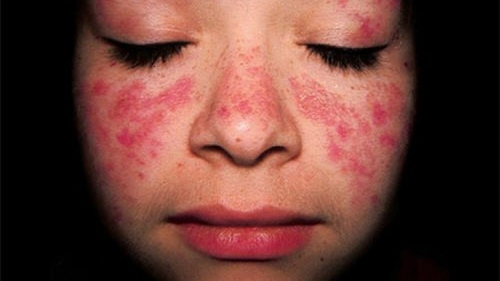 Tình trạng này có thể do bệnh lupus ban đỏ hệ thống