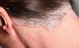 Vảy nến da đầu là một bệnh lý da liễu xảy ra khi tế bào da đầu tăng sinh bất thường