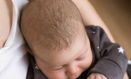Hình ảnh viêm da tiết bã da đầu ở trẻ sơ sinh