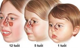 Viêm xoang ở trẻ em hay còn gọi là viêm xoang mũi là một tình trạng nhiễm trùng lớp niêm mạc lót trong các khoang xoang ở trẻ