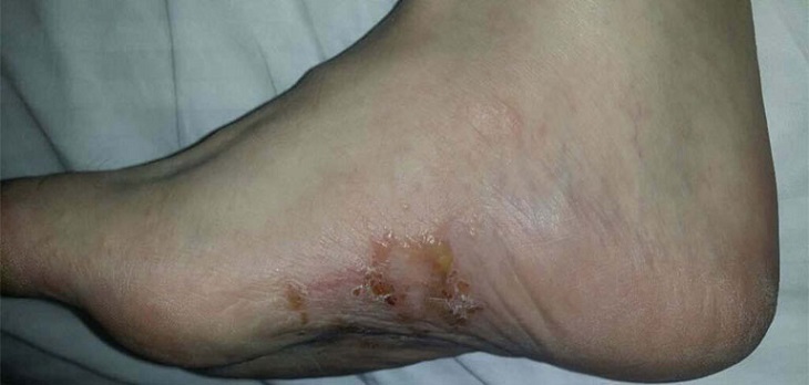 Bệnh tổ đỉa ở chân là bệnh lý viêm da thường gặp. Người bệnh xuất hiện các mụn nước li ti đặc trưng ở lòng bàn chân, ngón chân hoặc cả bản chân