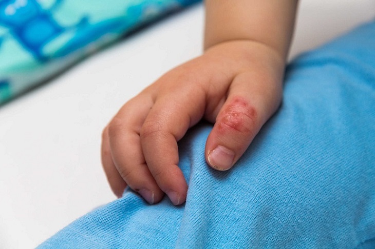 Bệnh tổ đỉa ở trẻ em là bệnh lý viêm da ở trẻ nhỏ có đặc trưng là các mụn nước sâu, dày và cứng ở bàn tay và bàn chân