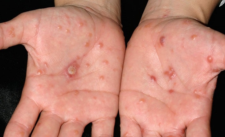 Bệnh có đặc trưng là các mụn nước mọc khu trú tại bàn tay hoặc bàn chân