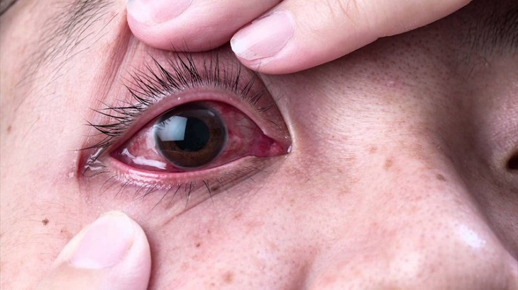 Huyệt Thừa Khấp có thể chữa được bệnh đau mắt đỏ 