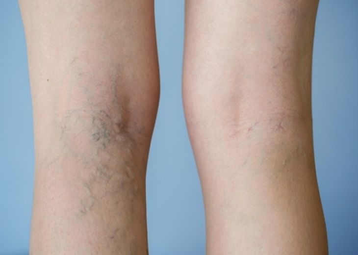 Phụ nữ bị tê chân sau sinh mổ thường kèm theo hiện tượng nổi mạch máu và gân xanh dưới da, nhìn rất rõ ràng.