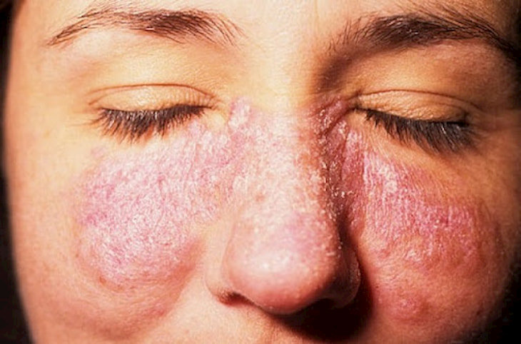 Lupus ban đỏ hệ thống gây tình trạng khô da, bong tróc