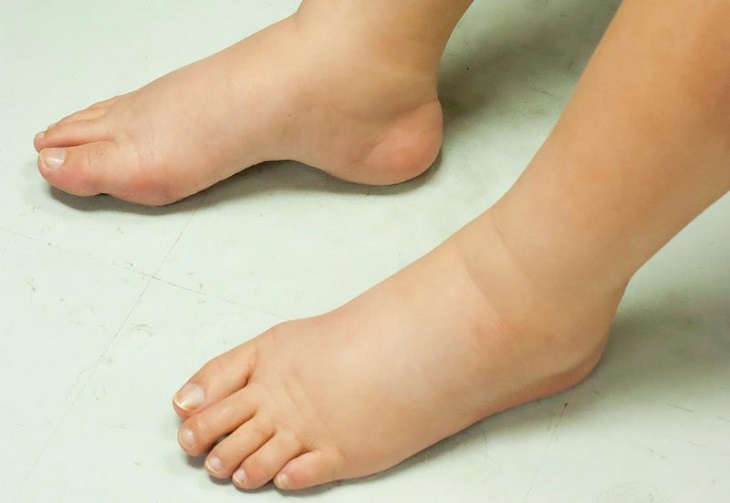 Sưng phù tây chân là một trong những dấu hiệu của bệnh