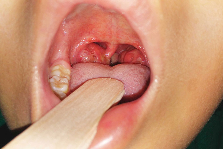 Viêm họng gây biến chứng viêm amidan