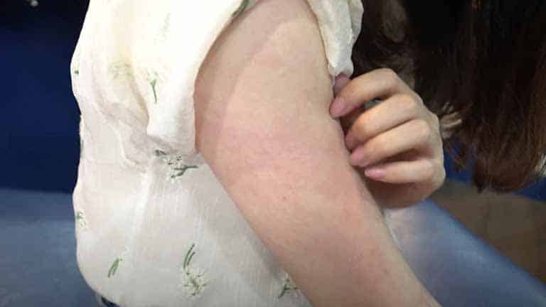 Khắp cánh tay Mỹ Linh nổi đặc mẩn đỏ do căn bệnh viêm da