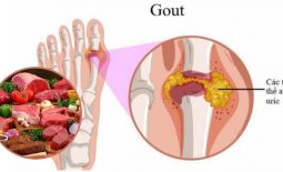 Bệnh gout nên ăn thịt gì