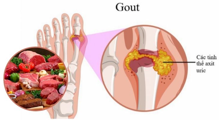 Bệnh gout nên ăn thịt gì